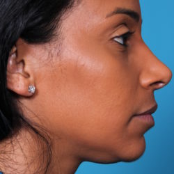 bw-afterleft-jpeg-jpg