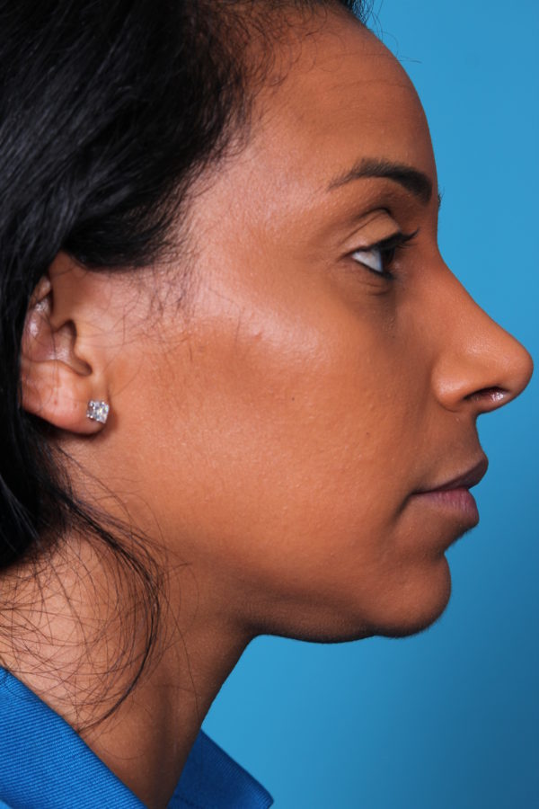 bw-afterleft-jpeg-jpg