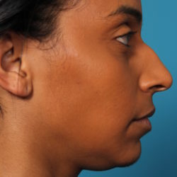 bw-beforeleft-jpeg-jpg