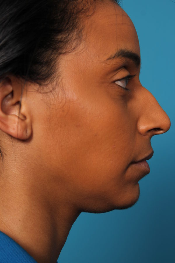 bw-beforeleft-jpeg-jpg