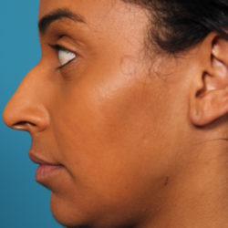 bw-beforeright-jpeg-jpg