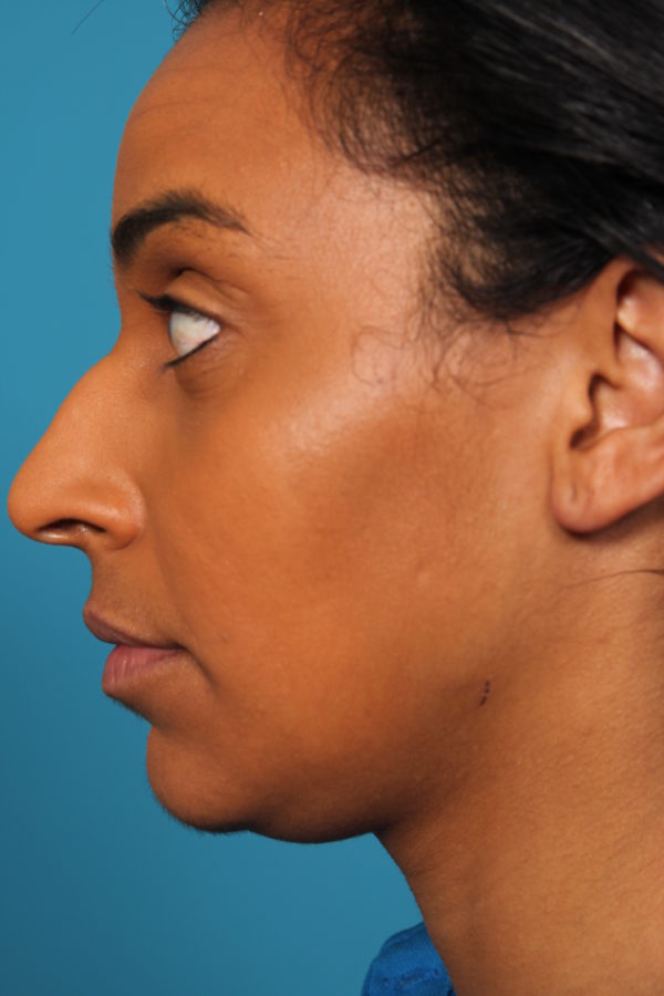 bw-beforeright-jpeg-jpg