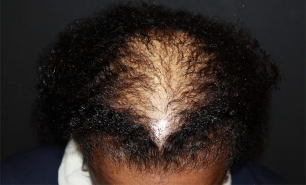 bansal-before-and-after-together-watermark-3-before-1-jpg