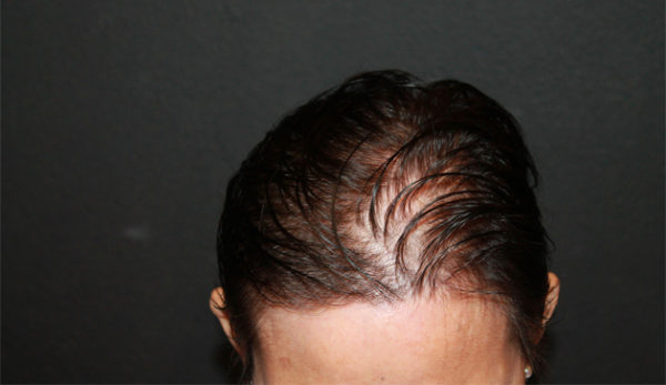 bansal-before-and-after-together-watermark-5-before-1-jpg