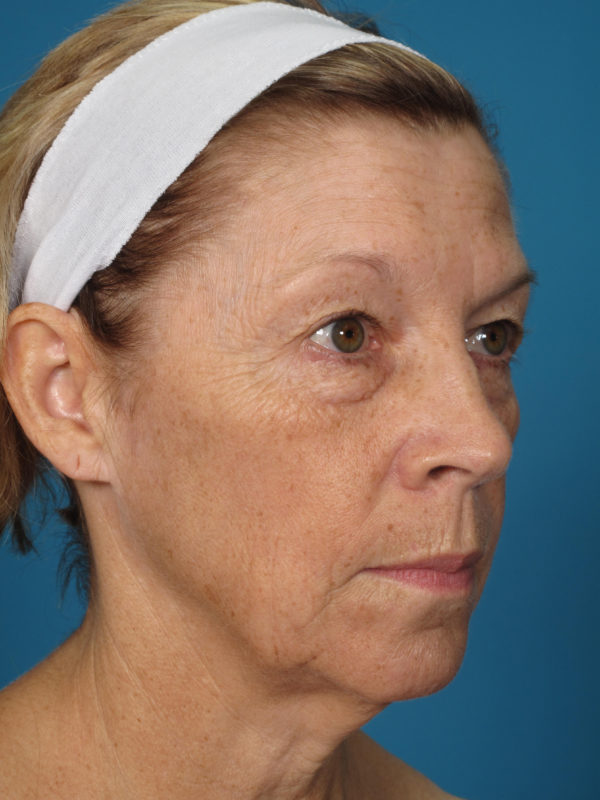 clhaquarterbedit-jpg