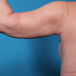 dr-man-arm-lift-patient-1-after-jpg