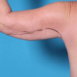 dr-man-arm-lift-patient-1-before-jpg