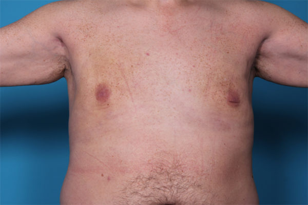 dr-man-gynecomastia-patient-1-after-jpg