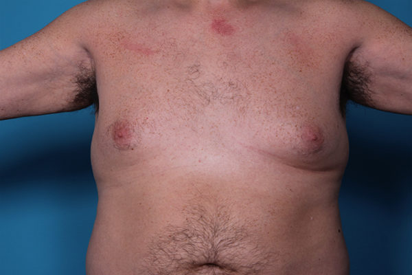 dr-man-gynecomastia-patient-1-before-jpg