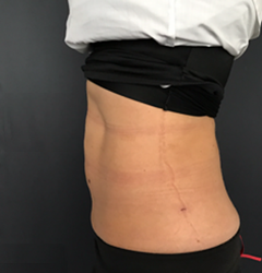 dr-man-j-plasma-before-and-after-patient-2-after-png