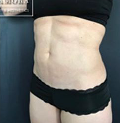 dr-man-j-plasma-before-and-after-patient-3-after-2-png