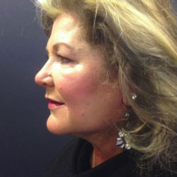 dr-man-j-plasma-before-and-after-patient-4-full-image-after-jpg