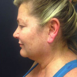 dr-man-j-plasma-before-and-after-patient-4-before-jpg