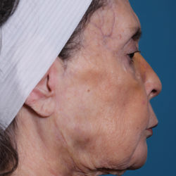 dr-man-j-plasma-patient-1-after-right-jpg