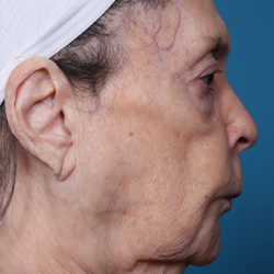 dr-man-j-plasma-patient-1-before-right-jpg