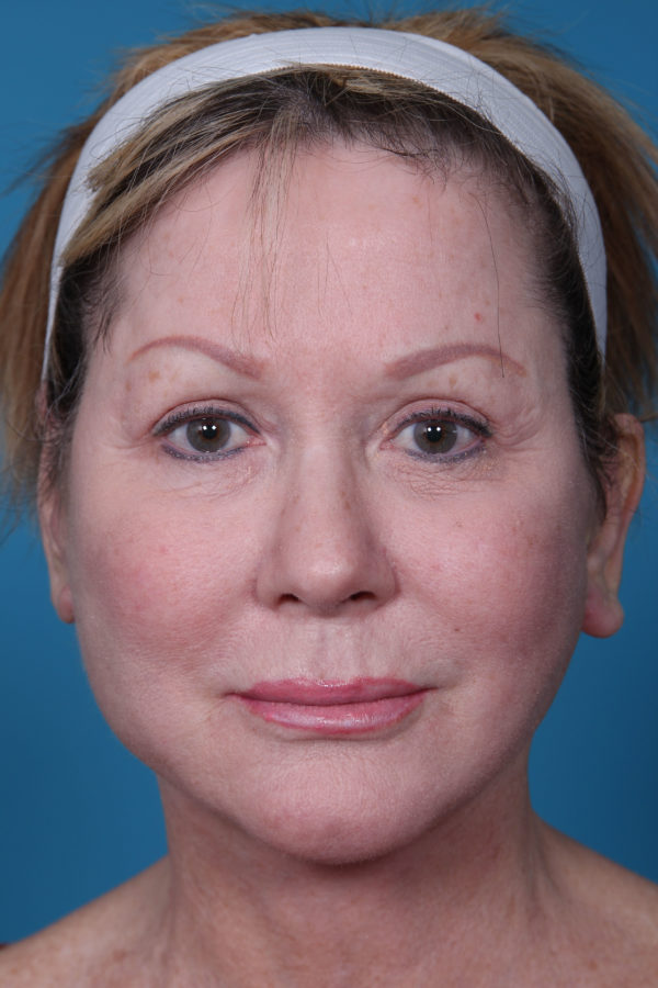 ka-facelift-after-jpg