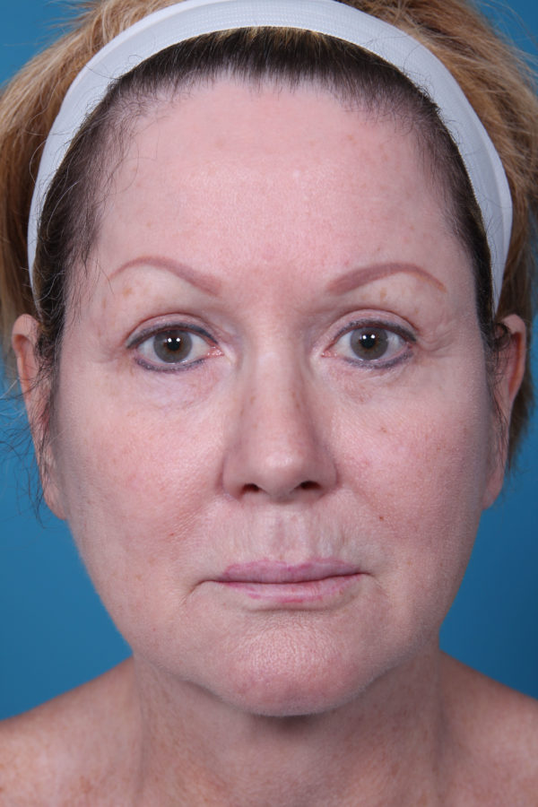 ka-facelift-before-jpg