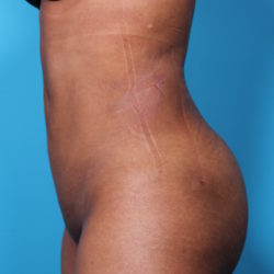 mc-afterleft-jpeg-jpg