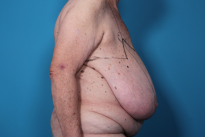 Breast Reduction Before Surgery | Daniel Man MD | Reduction Mammoplasty | Boca Raton, FL