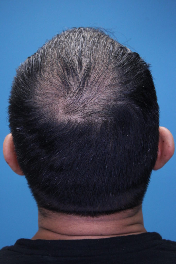 Hair Restoration Boca Raton Hair Rejuvenation Palm Beach