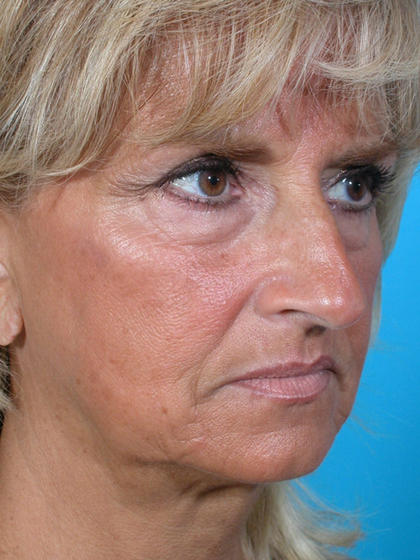 rorequarterbedit-jpg