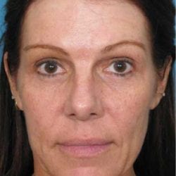 forehead-lift-dr-daniel-man-sumefront1-jpg