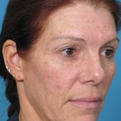 forehead-lift-dr-daniel-man-sumeside1-copy-jpg