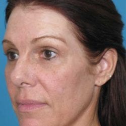 forehead-lift-dr-daniel-man-sumeside2-jpg