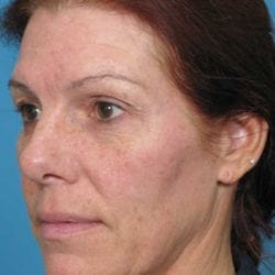 forehead-lift-dr-daniel-man-sumeside2-copy-jpg