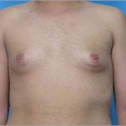 gynecomastia-dr-daniel-man-brdifront1-jpg