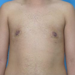 gynecomastia-dr-daniel-man-brdifront1-copy-jpg