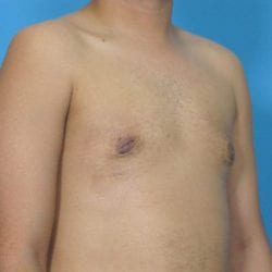 gynecomastia-dr-daniel-man-brdiside1-jpg