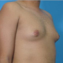 gynecomastia-dr-daniel-man-brdiside1-copy-jpg