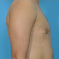 gynecomastia-dr-daniel-man-brdiside2-jpg
