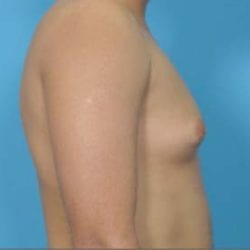 gynecomastia-dr-daniel-man-brdiside2-copy-jpg