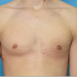 gynecomastia-dr-daniel-man-evbufront1-jpg