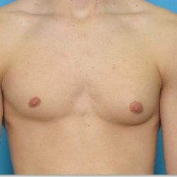 gynecomastia-dr-daniel-man-evbufront1-copy-jpg