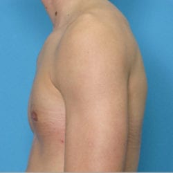 gynecomastia-dr-daniel-man-evbuside1-jpg