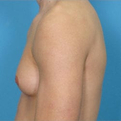 gynecomastia-dr-daniel-man-evbuside1-copy-jpg