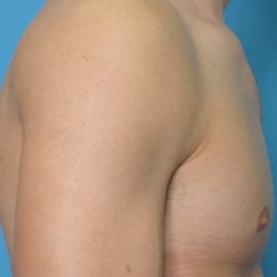 gynecomastia-dr-daniel-man-evbuside2-jpg