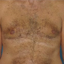 gynecomastia-dr-daniel-man-thtufront1-jpg