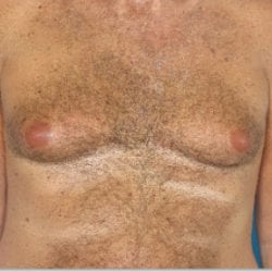 gynecomastia-dr-daniel-man-thtufront1-copy-jpg