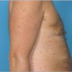 gynecomastia-dr-daniel-man-thtuside1-jpg