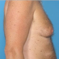 gynecomastia-dr-daniel-man-thtuside1-copy-jpg