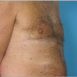 gynecomastia-dr-daniel-man-thtuside2-jpg