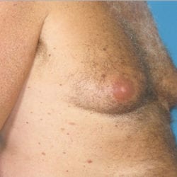 gynecomastia-dr-daniel-man-thtuside2-copy-jpg