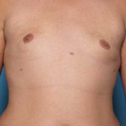 gynecomastia-dr-daniel-man-trsafront1-jpg