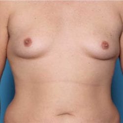 gynecomastia-dr-daniel-man-trsafront1-copy-jpg