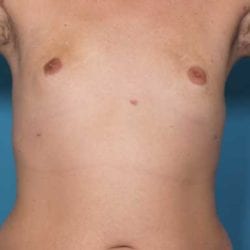 gynecomastia-dr-daniel-man-trsafront2-jpg
