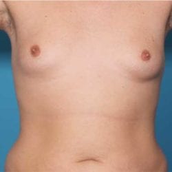 gynecomastia-dr-daniel-man-trsafront2-copy-jpg